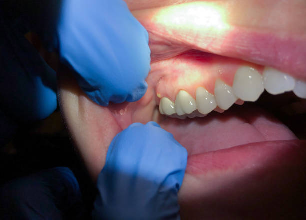 Best Emergency Dentist for Knocked-Out Tooth in Muenster, TX